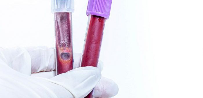 Generic photograph of two blood test vials held by a white-gloved hand