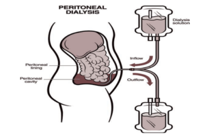 Diagram showing the peritoneal dialysis procedure