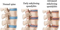 Image showing a normal spine, early ankylosing spondylitis and advanced ankylosing spondylitis 