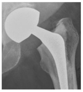 A hemi-arthroplasty is the replacement of the head of the femur only, and is carried out when the socket is intact