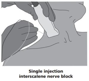 Diagram showing the interscalene nerve block being injected into the side of the neck