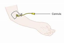 Graphic of cannula inserted into arm