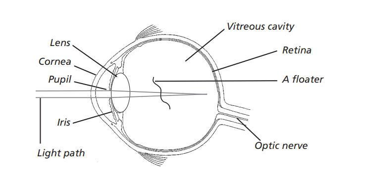 diagram of the eye showing a floater in the path of light in the eye