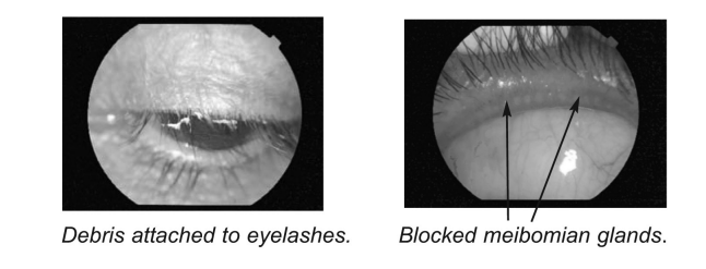 Two photos of the eye, one showing debris attached to eyelashes, the second showing the location of the meibomian glands between the eyelashes and the eye.