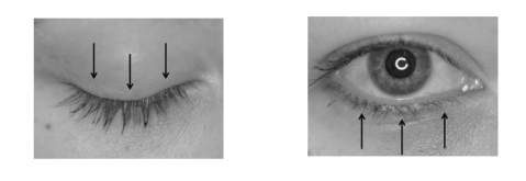 Two photos of the eye, showing the correct direction for massage