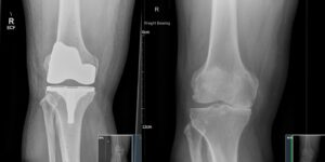 X ray with two knee joints